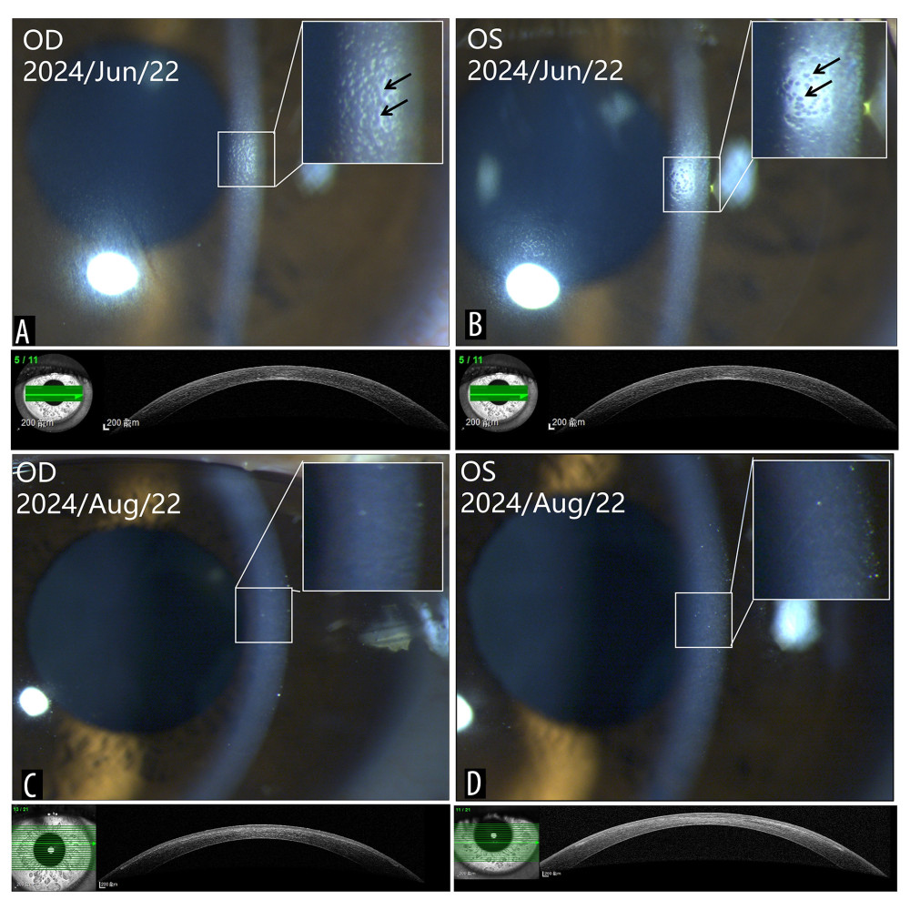 Images showing slit lamp examination and anterior segment optical coherence tomography (AS-OCT; Anterion, Heidelberg, Germany). (A) right (OD) and (B) left (OS) hyporeflective endothelial changes (indicated by the black arrows) visible on the endothelial surface of both eyes, with corneal edema in the right eye on the third day after surgery; (C) right and (D) left 6 months postoperatively. The corneal endothelial surface is smooth, with a small amount of stromal haze. Corneal OCT showed no significant abnormalities.