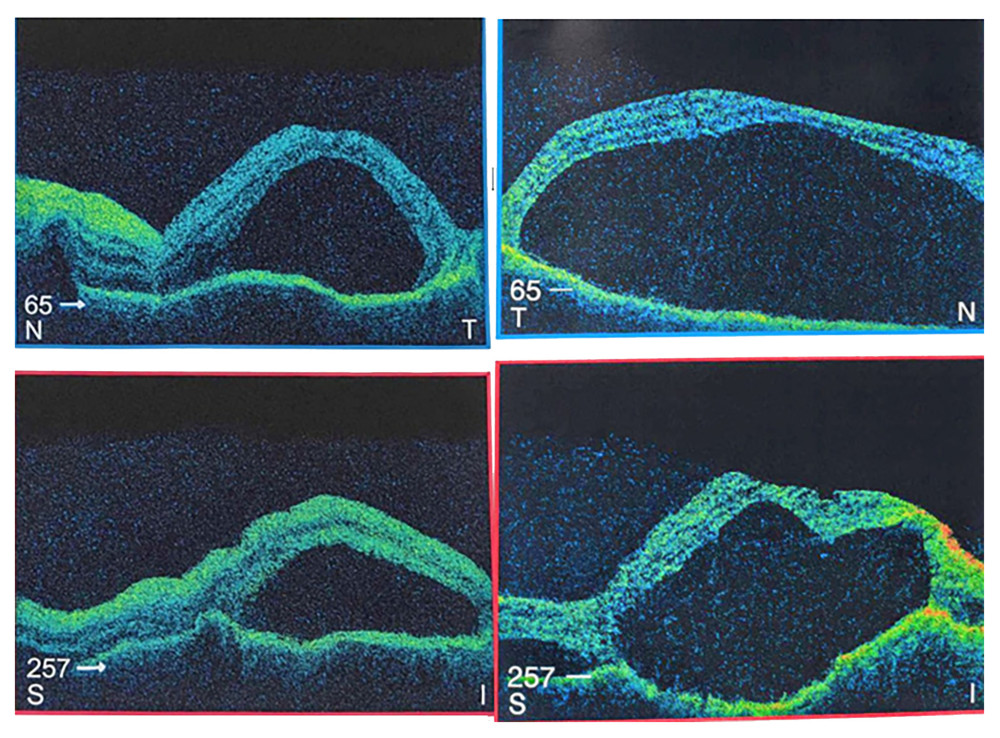 Spectral-domain optical coherence tomography of both eyes demonstrating multilobulated serous retinal detachments with subretinal fluid septations and optic disc edema, consistent with acute Vogt-Koyanagi-Harada disease.