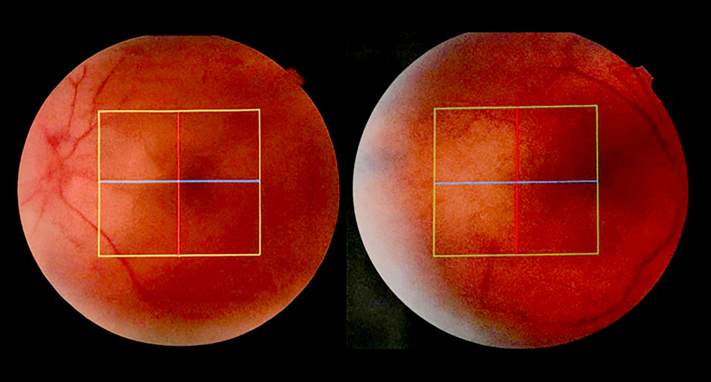 Color fundus photographs of both eyes demonstrating optic disc hyperemia, diffuse retinal elevation, and loss of the foveal contour associated with serous retinal detachment in acute Vogt-Koyanagi-Harada disease.
