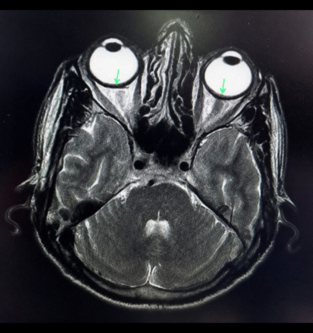 Magnetic resonance imaging of the brain and orbits demonstrating bilateral focal nodular choroidal lesions (arrows), supporting the presence of active choroidal inflammation in Vogt-Koyanagi-Harada disease.