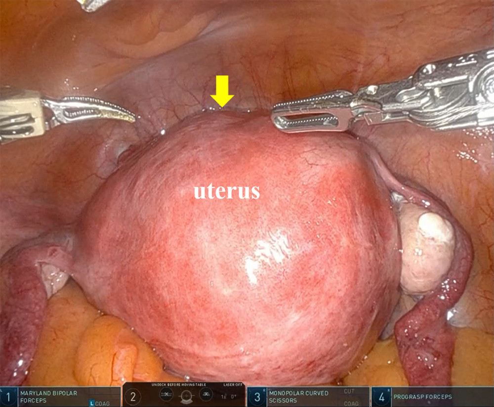 Intraoperative findings at the beginning of RASH. The enlarged uterus caused by adenomyosis was visible within the pelvic cavity (arrow). RASH, robot-assisted hysterectomy.