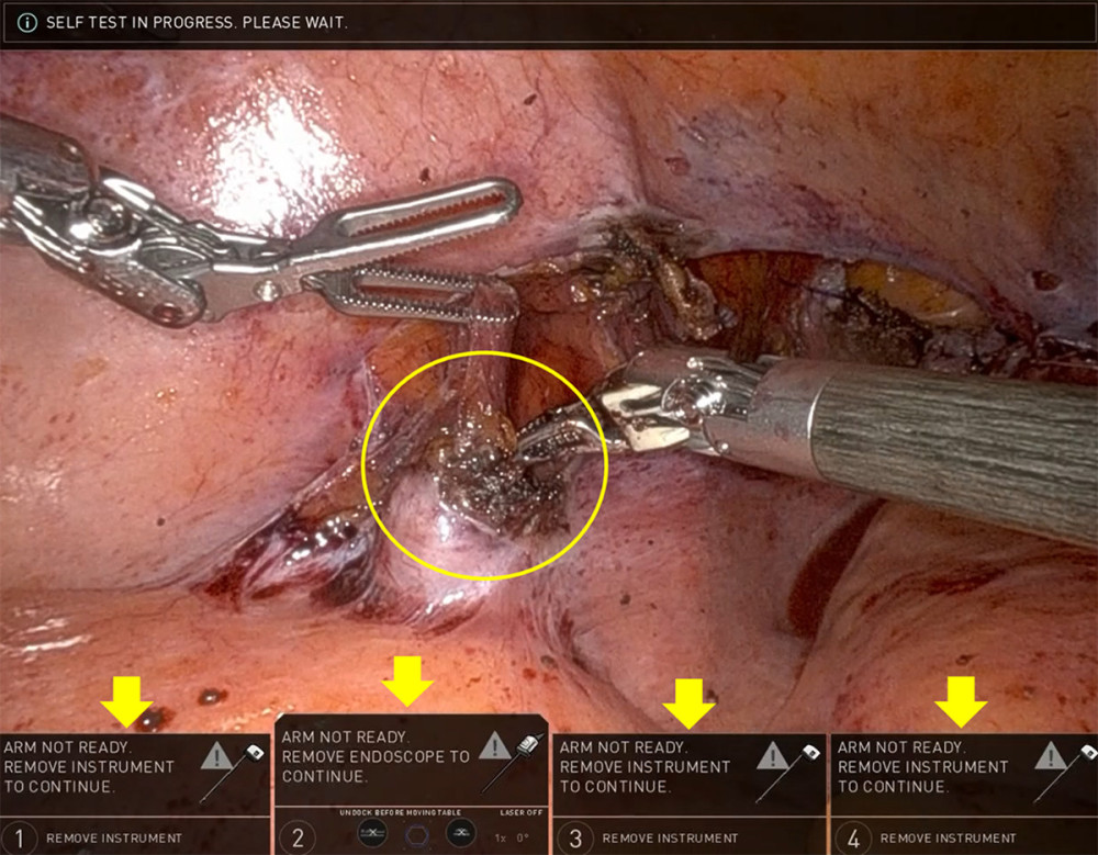 Emergency shutdown of the robotic system during RASH. After completion of vaginal cuff closure and intraperitoneal irrigation, an unrecoverable emergency shutdown of the da Vinci X system occurred during confirmation of hemostasis around the left infundibulopelvic ligament (circle). The console operation was suddenly disabled, making continuation of intracorporeal robotic manipulation impossible. The robotic system error messages displayed on the console monitor are shown (arrows). RASH, robot-assisted hysterectomy.