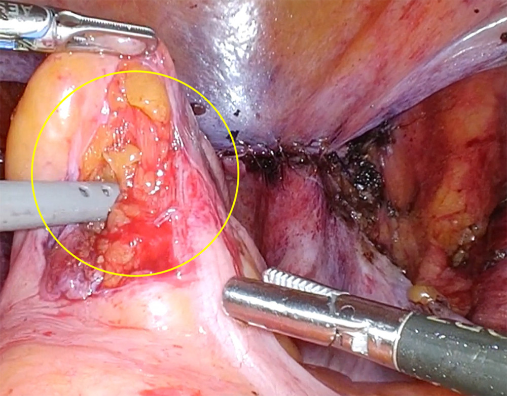 Intraoperative finding of rectal serosal injury (circle) that occurred during mobilization of the rectum using the prograsp forceps. The defect measured approximately 3 cm and was repaired laparoscopically using a single interrupted suture.