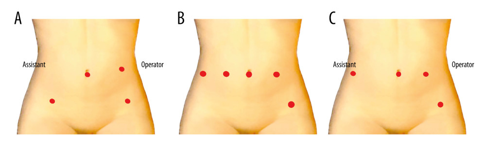Comparison of port placement between standard laparoscopic surgery and robot-assisted surgery. (A) Port placement during standard laparoscopic surgery. (B) Port placement during robotic surgery. (C) Port placement after conversion from robotic surgery to laparoscopic surgery.