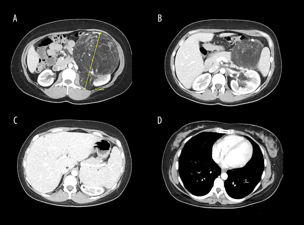 Axial views of contrast-enhanced computed tomography demonstrating a large left renal angiomyolipoma (AML). The tumor measures 16.7 cm in maximal axial dimension and arises from the left kidney (A). Associated tumor thrombus is visualized within the left renal vein causing partial luminal occlusion (B), extending into the inferior vena cava (IVC) (C), and reaching the right atrium adjacent to the tricuspid valve, with intermittent prolapse into the right ventricle (D).
