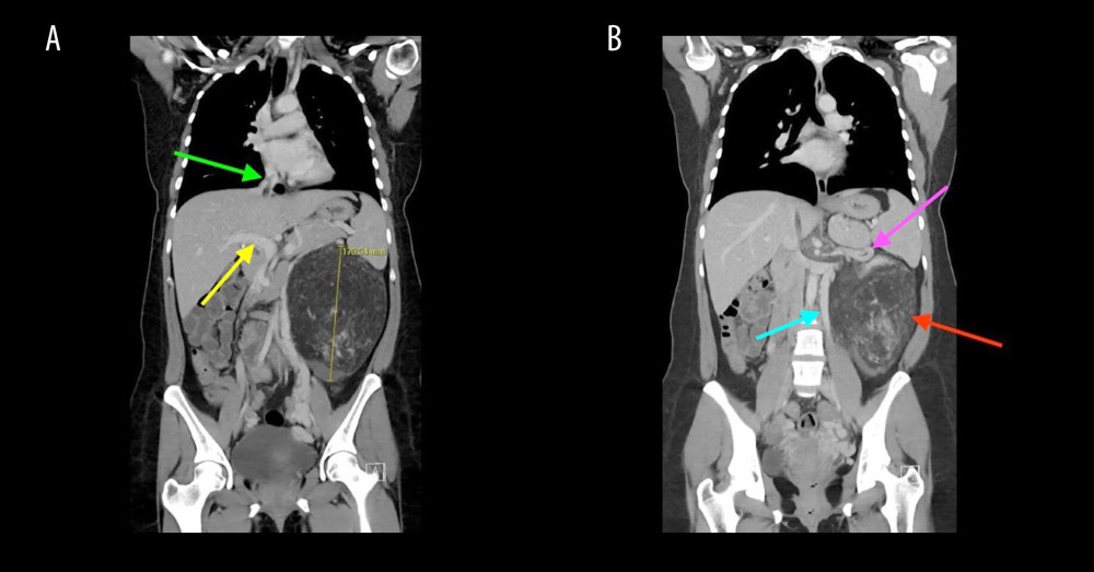 Coronal views of contrast-enhanced computed tomography demonstrating a giant left renal angiomyolipoma measuring 19.5 × 18.0 × 10.5 cm (maximal dimension 17.0 cm) with a contiguous tumor thrombus measuring approximately 18 cm in length extending through the left renal vein into the inferior vena cava and reaching the right atrium. Panel (A) demonstrates the inferior vena cava (green arrow) and portal vein (yellow arrow), shown for anatomic orientation and illustrating the path of tumor thrombus extension toward the heart. Panel (B) demonstrates the primary left renal angiomyolipoma (red arrow) with tumor thrombus extending through the left renal vein (pink arrow). A dilated left ovarian vein varix consistent with secondary pelvic congestion syndrome due to high-flow tumor physiology is also visualized (blue arrow). No infiltrative parenchymal or metastatic disease is identified within the abdomen, pelvis, or chest.