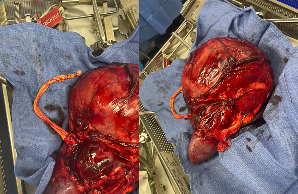 Intraoperative images demonstrating en bloc removal of the left renal angiomyolipoma with complete excision of the extensive tumor thrombus extending from the renal vein through the inferior vena cava.