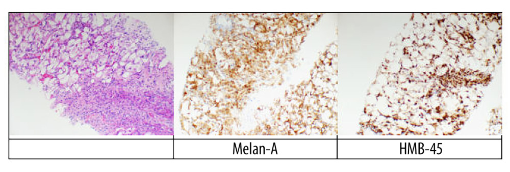 Histopathologic findings of renal angiomyolipoma. Low-power hematoxylin and eosin (H&E) section demonstrates classic triphasic morphology with an admixture of mature adipose tissue, thick-walled blood vessels, and smooth muscle bundles (× 40). Higher-magnification view highlights perivascular epithelioid cells with clear cytoplasm and mild nuclear pleomorphism (× 200). Immunohistochemical staining demonstrates positivity for HMB-45 and smooth muscle actin, confirming the diagnosis of angiomyolipoma.