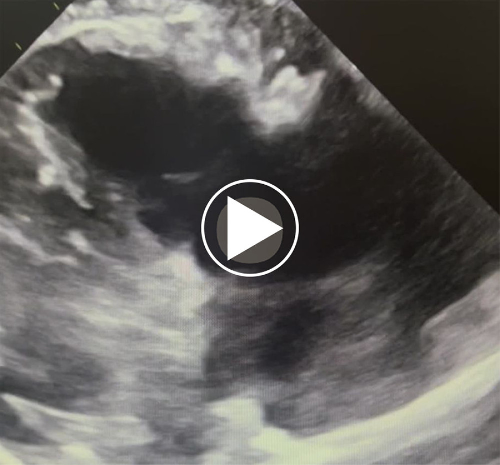 Transthoracic echocardiography demonstrating a mobile angiomyolipoma-associated tumor thrombus within the right atrium, intermittently prolapsing across the tricuspid valve into the right ventricle during diastole.