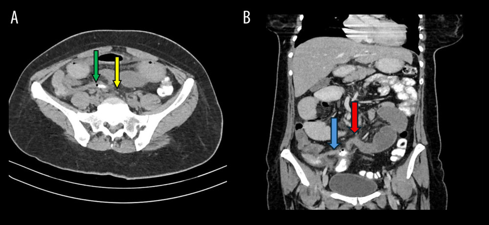 (A) Axial computed tomography image showing a fistulous communication between the appendix and sigmoid colon, with a thin streak of rectal contrast entering the appendiceal lumen (green arrow) and the adjacent sigmoid colon (yellow arrow). (B) Coronal computed tomography image showing an inflamed appendix containing an air bubble (blue arrow) in close proximity to the sigmoid colon, with dilated small bowel loops (red arrow).
