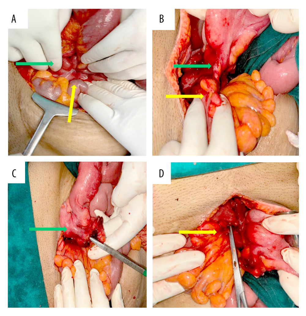 (A) Intraoperative image showing the appendix (green arrow) adjacent to the small bowel (yellow arrow) and sigmoid colon (white arrow). (B) Fistulous communication between the tip of the appendix (green arrow) and the sigmoid colon (yellow arrow). (C) After division of the fistulous tract, a metal forceps is visible within the appendiceal lumen (green arrow). (D) After division of the fistulous tract, the opening in the sigmoid colon is visible separately, with a metal forceps inserted into the lumen (yellow arrow).