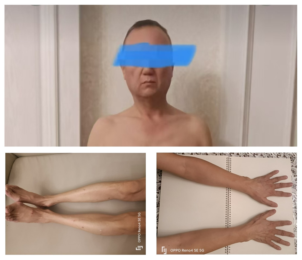 Atrophy of subcutaneous fat in the buttocks and limbs, accompanied by pronounced muscle atrophy of the lateral gluteal regions.