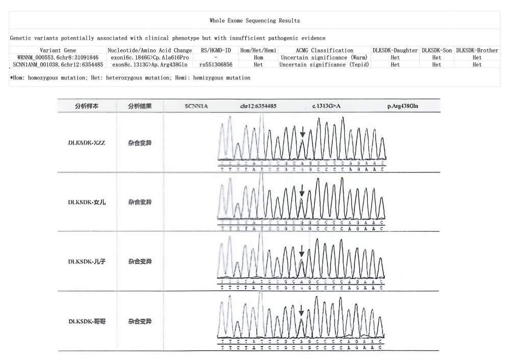 Whole-exome sequencing revealed a homozygous WRN gene mutation, c.1846G>C (p.Ala616Pro). The patient’s daughter, son, and 1 brother carried the mutation in the heterozygous state.