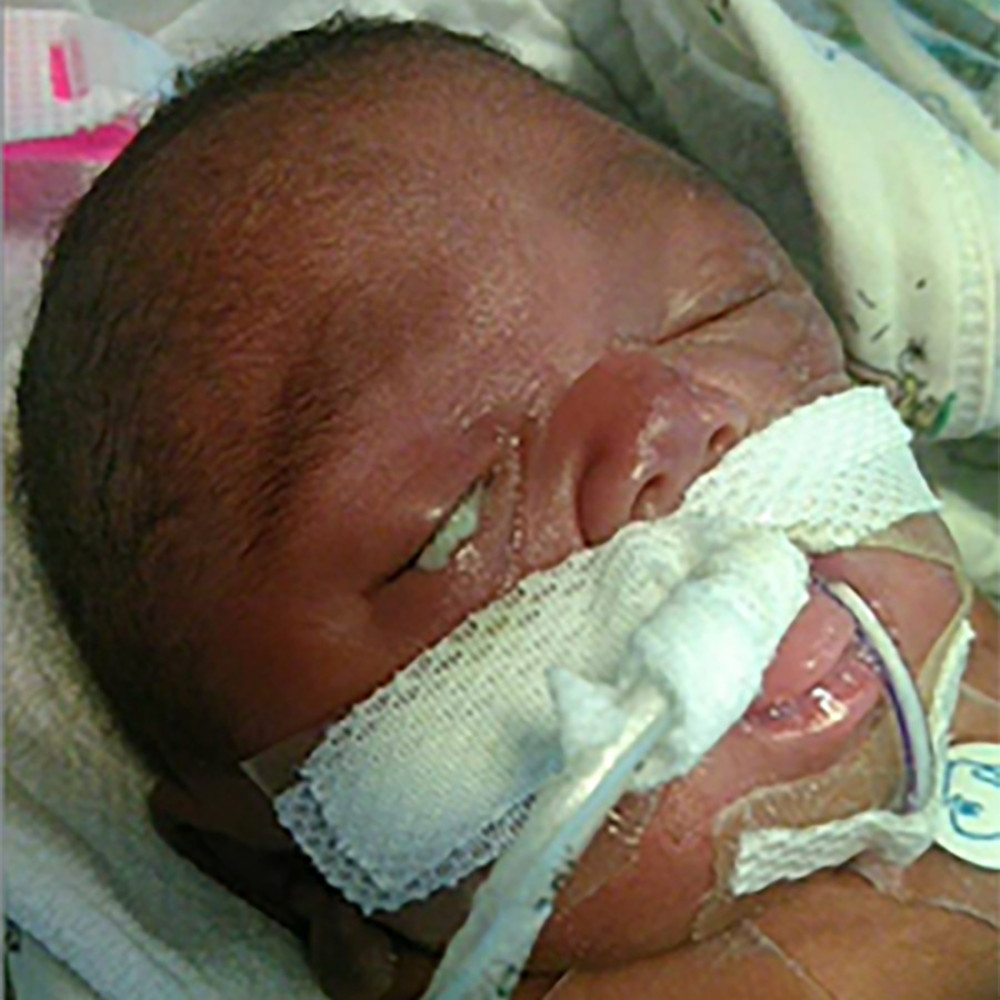 Photograph showing drainage spontaneously seeping from the right eye on day 48 of life.