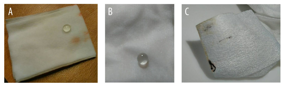 Photographs of collected contents expelled from the right eye. (A, B) Clear, firm tissue maintaining its shape after expulsion from the right eye, suspected to represent the crystalline lens. (C) Clear gel-like material and hyperpigmented tissue expelled from the right eye, suspected to represent vitreous humor and choroidal tissue.