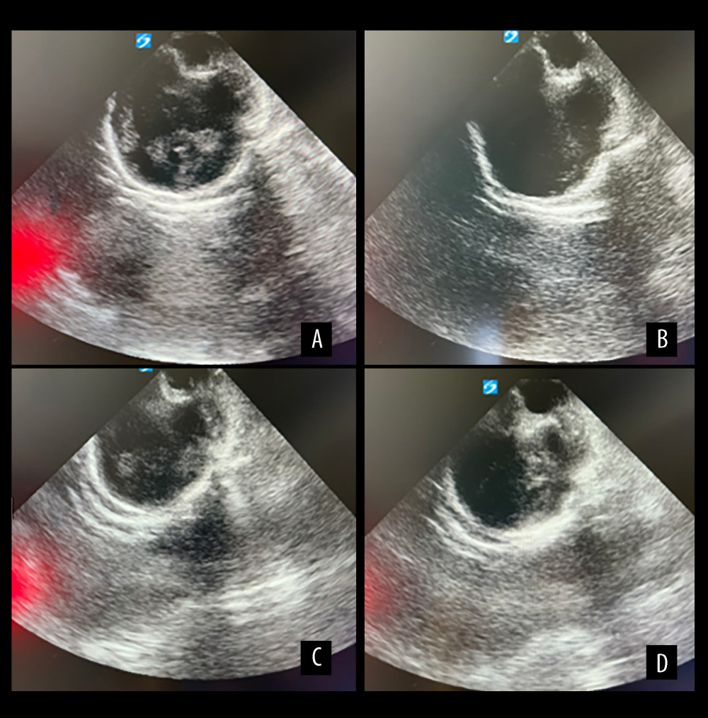 B-scan ultrasonography of the right eye demonstrating intravitreal condensations and distorted globe architecture (A, B), and of the left eye demonstrating intravitreal condensations (C, D).