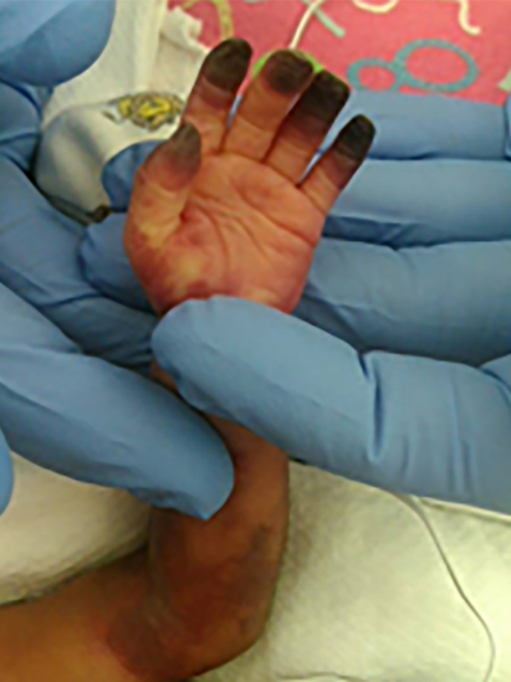 Photograph of the left upper extremity demonstrating pronounced bruising and necrosis of the fingertips.