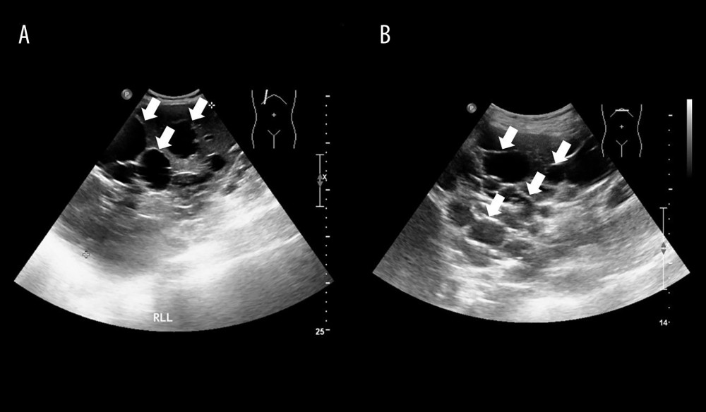 Abdominal ultrasonography. Ultrasound images demonstrate numerous anechoic ovoid lesions (arrows) occupying the majority of the right (A) and left (B) hepatic lobes, consistent with multiple hepatic cysts.