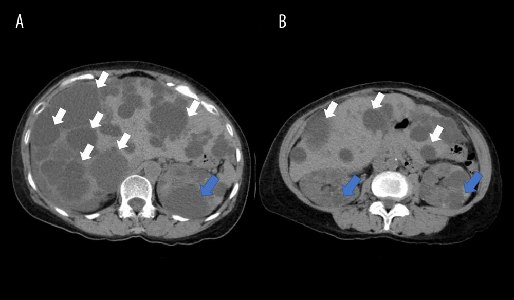 Contrast-enhanced computed tomography of the abdomen. Axial contrast-enhanced computed tomography images (A, B) demonstrate numerous hypodense ovoid lesions of varying sizes throughout the liver (white arrows) and both kidneys (blue arrows), consistent with hepatic and renal cysts.