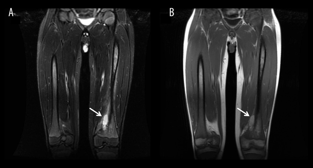 Magnetic resonance imaging findings during acute skeletal presentation.Coronal magnetic resonance imaging of the lower extremities. (A) Short tau inversion recovery sequence demonstrates a heterogeneous area of increased signal intensity within the distal metaphysis and diaphysis of the left femur, suggestive of bone marrow edema or infiltration. (B) Corresponding T1-weighted image shows reduced signal intensity in the same region, indicating replacement of normal bone marrow. White arrows indicate the abnormal marrow lesion within the distal femur. No cortical destruction or periosteal reaction is observed. Overall, the imaging findings are consistent with an acute bone crisis in Gaucher disease.
