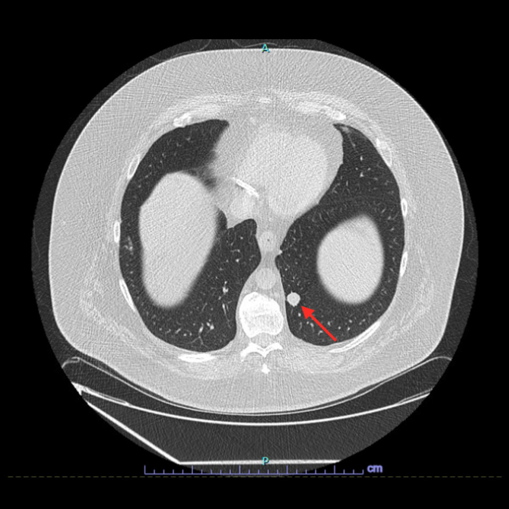 Low-dose computed tomography scan demonstrating a 1.6-cm left lower lobe pulmonary nodule (arrow).