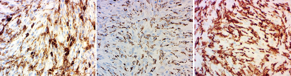 Immunohistochemical staining at 400× magnification showing positive expression of CD4, CD68, and CD163 from left to right, confirming histiocytic differentiation.