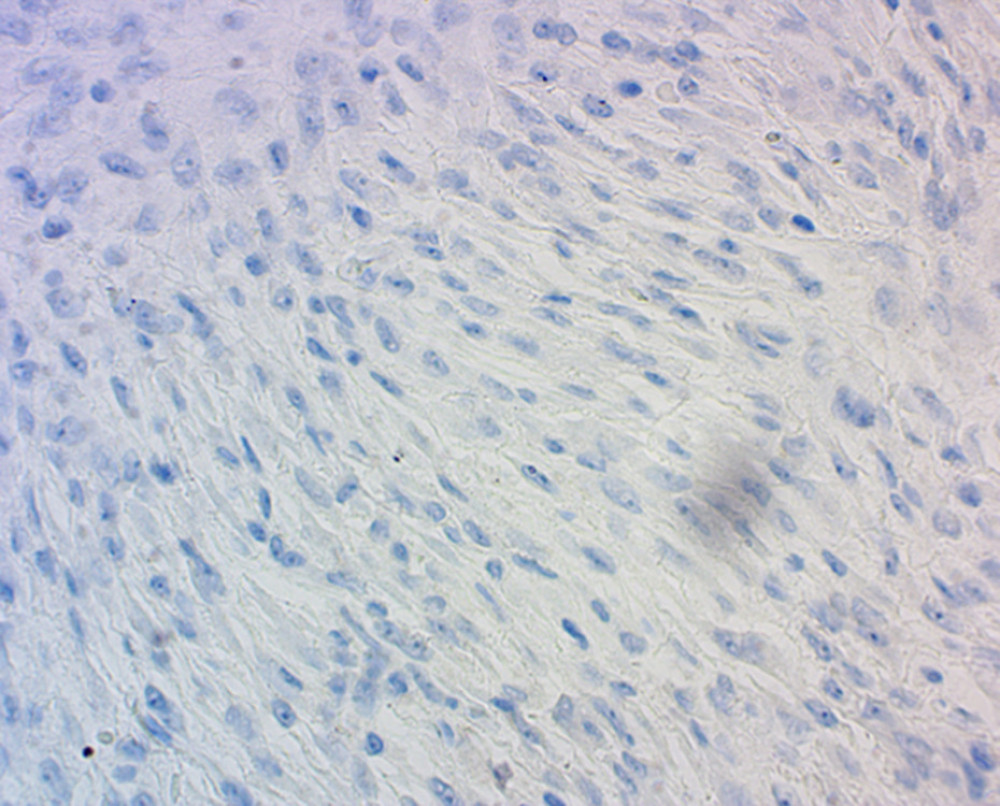 Immunohistochemical staining at 400× magnification showing absence of CD1a immunoreactivity, an important marker of Langerhans cell differentiation.