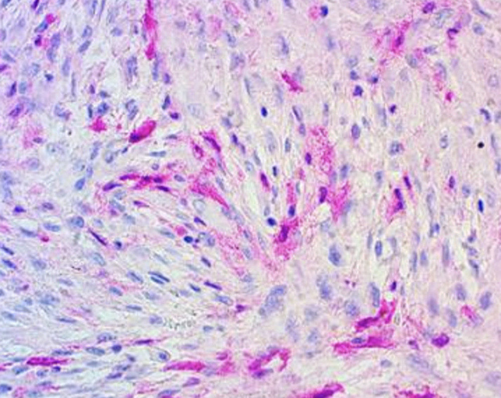 Immunohistochemical staining at 400× magnification demonstrating patchy cytoplasmic and nuclear S100 protein expression.