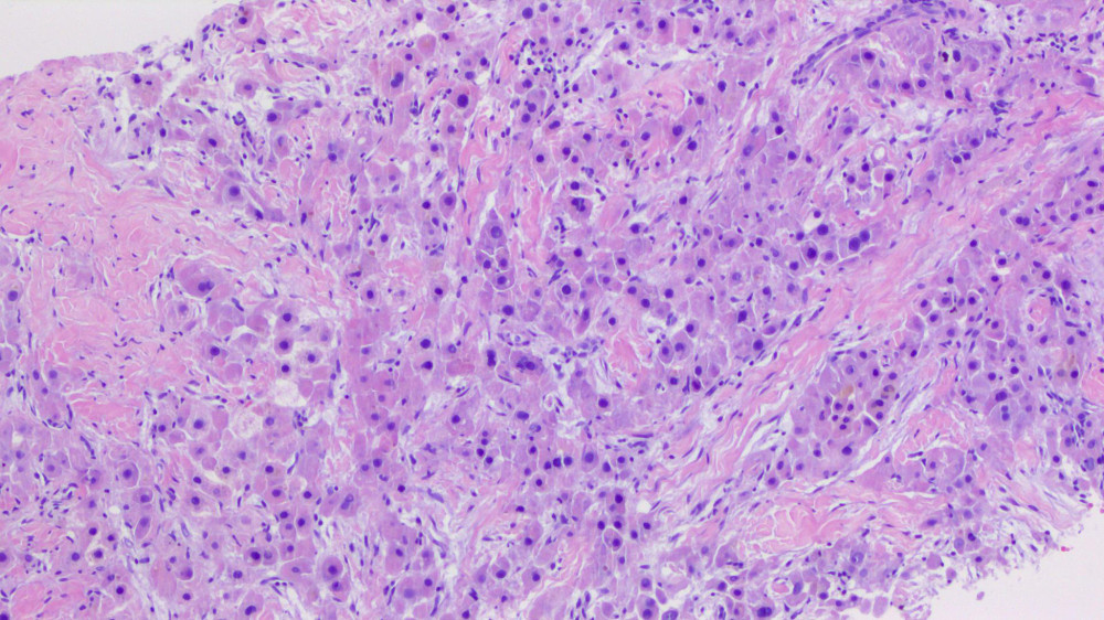 Biopsy from liver mass showing large pleomorphic neoplastic polygonal cells with abundant eosinophilic cytoplasm, nuclear inclusions, and prominent nucleoli arranged in nests and sheets, separated by collagenous fibrous bands characteristic of fibrolamellar hepatocellular carcinoma.