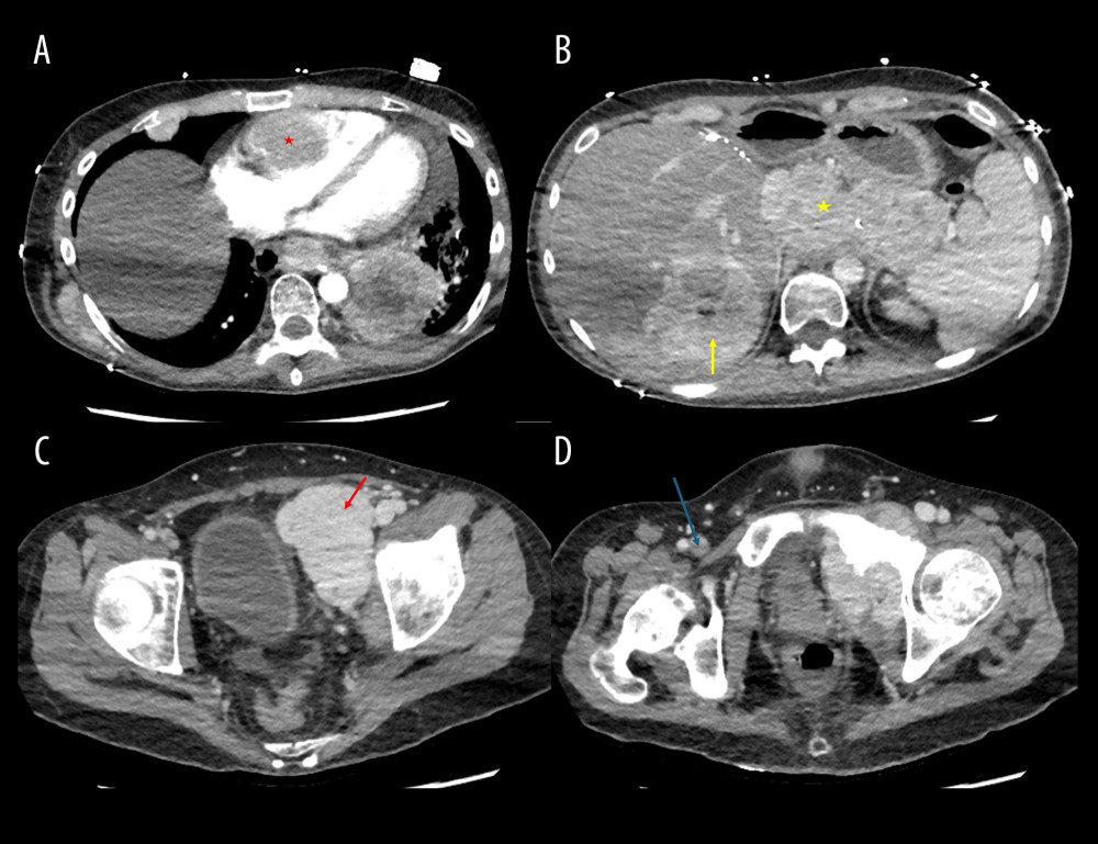 Contrast-enhanced computed tomography (CT) demonstrates widespread metastatic disease and thrombotic complications. Axial CT images show (A) a large intracardiac mass within the right ventricle (red star); (B) a 7.6 × 7.9 cm hepatic mass (yellow arrow) with additional intraperitoneal tumor deposits (yellow star); (C) a pelvic mass (red arrow); and (D) deep vein thrombosis in the right common femoral vein (blue arrow).