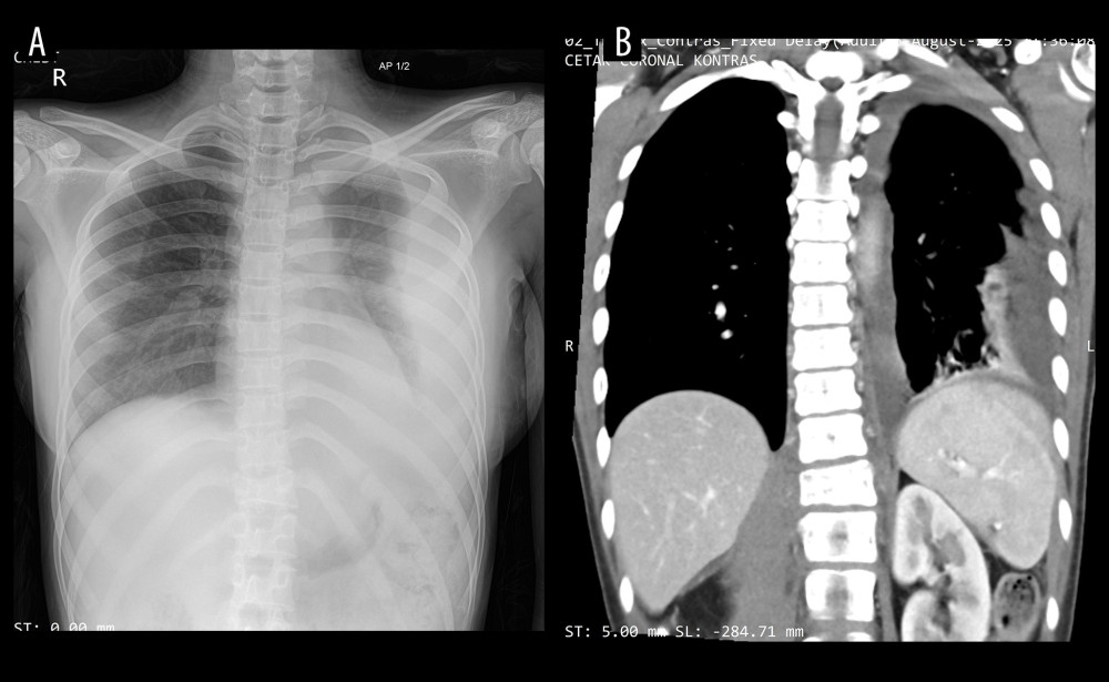 (A) Anteroposterior chest radiograph demonstrating left pleural effusion and compressive atelectasis of the left lower lung. (B) Contrast-enhanced thoracic computed tomography scan demonstrating infiltration of the T7–T12 vertebrae and epidural space.
