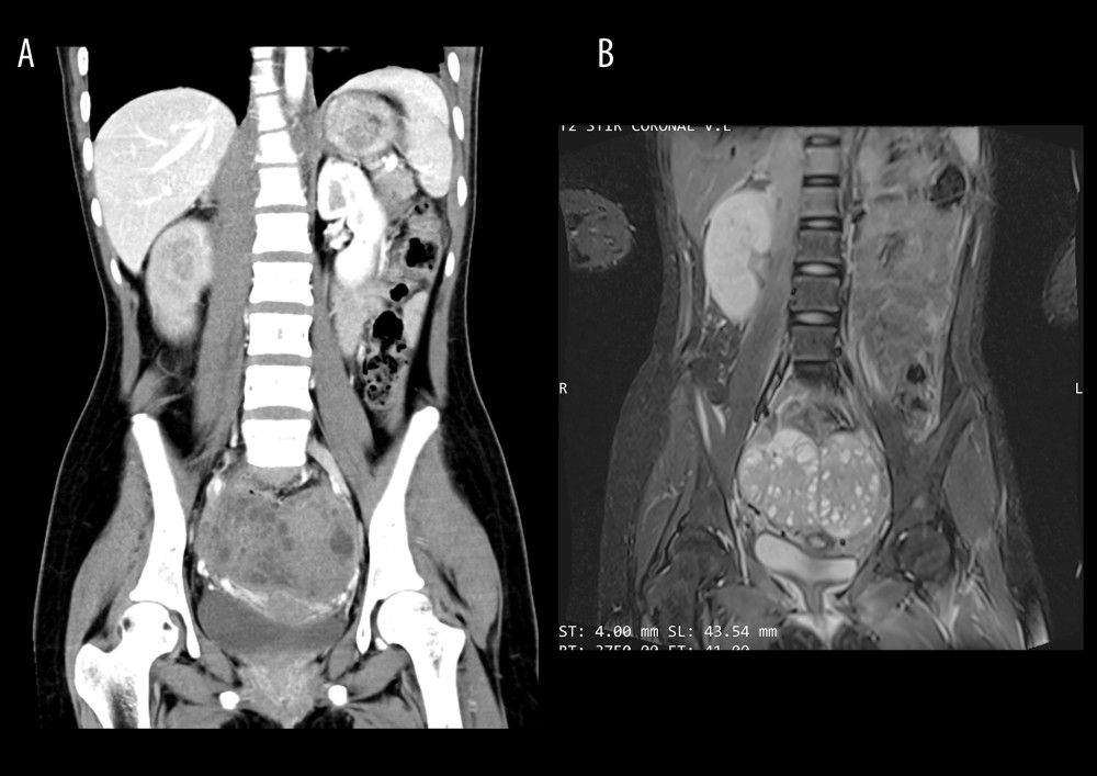 (A) Contrast-enhanced abdominal and lumbosacral computed tomography scan demonstrating compression of the T12 vertebra and a paravertebral mass extending from T11 to L3. (B) Contrast-enhanced abdominal and lumbosacral magnetic resonance image.