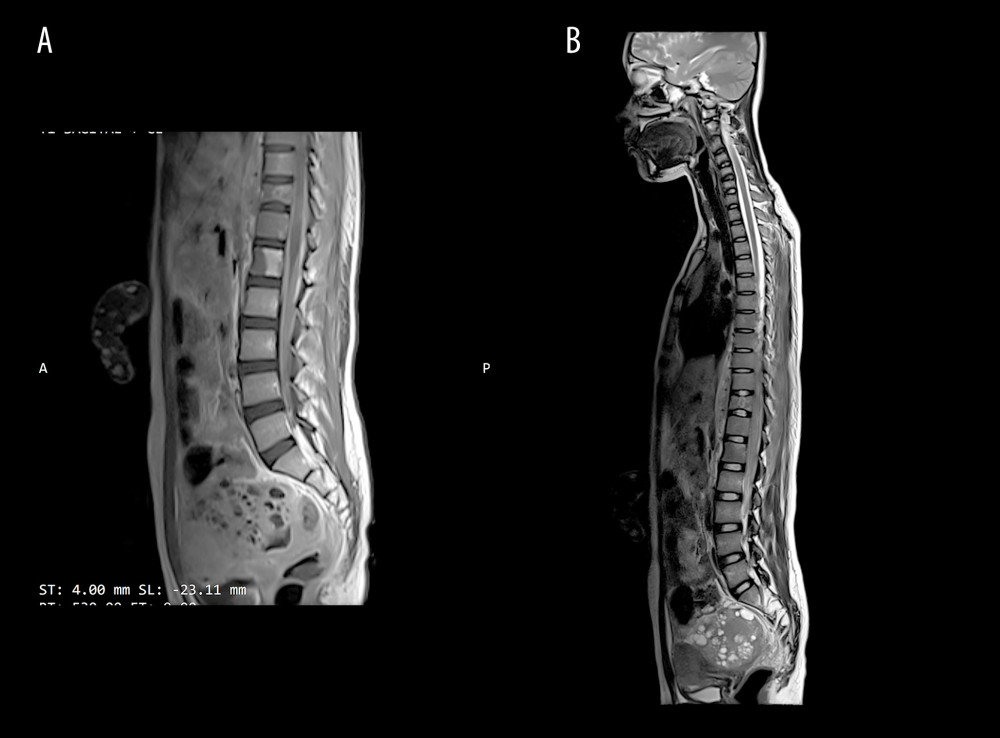 (A) Contrast-enhanced lumbar magnetic resonance image (sagittal view) demonstrating altered signal intensity of the L1 vertebra with a paravertebral mass extending from L1 to L3. (B) Contrast-enhanced thoracic magnetic resonance image demonstrating left-sided pleural effusion, compressive atelectasis involving segments 6 and 10 of the left lung, an anterior mediastinal lesion, a paravertebral mass, and bilateral adnexal masses.