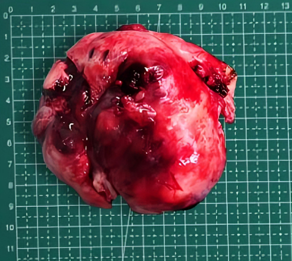 Right ovarian mass.