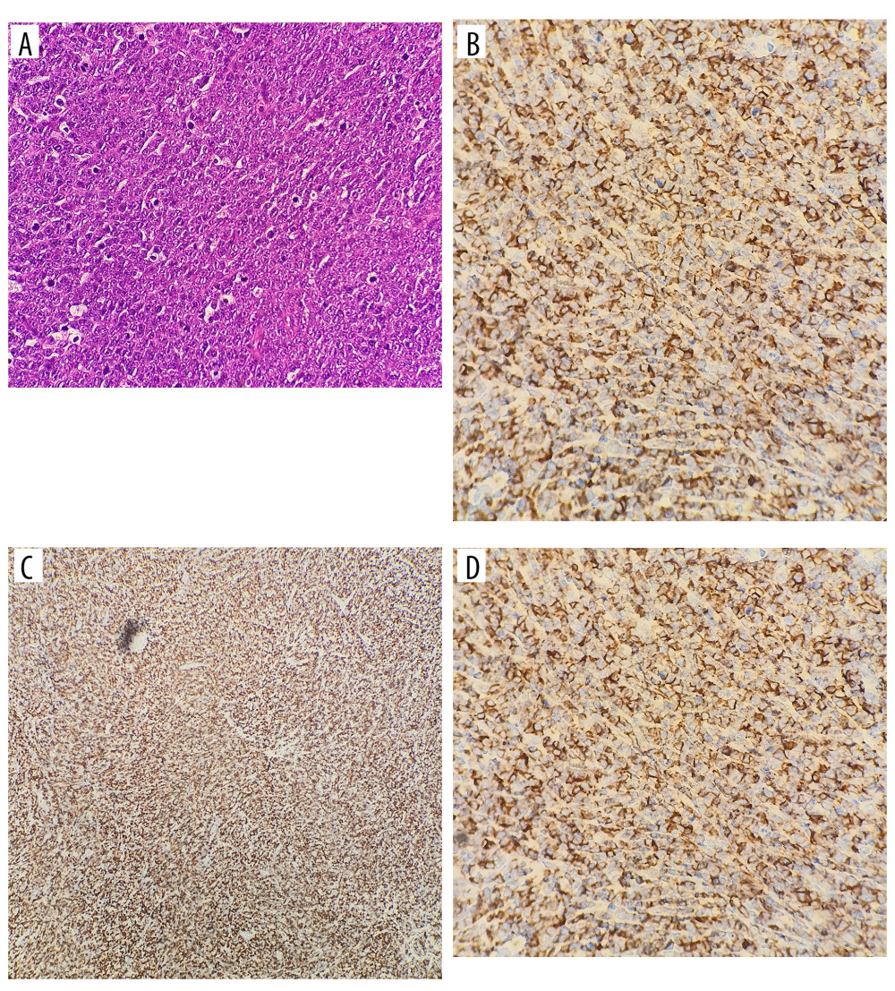 Immunohistochemical examination. (A) Hematoxylin and eosin staining demonstrating diffuse proliferation of large atypical lymphoid cells, consistent with diffuse large B-cell lymphoma. (B) CD20 immunohistochemical staining showing strong diffuse membranous positivity in neoplastic lymphoid cells, confirming B-cell lineage. (C) Ki-67 immunohistochemical staining demonstrating a high proliferative index (approximately 80%) within the tumor cell population. (D) CD3 immunohistochemical staining showing negative staining in neoplastic cells, supporting exclusion of T-cell lymphoma.