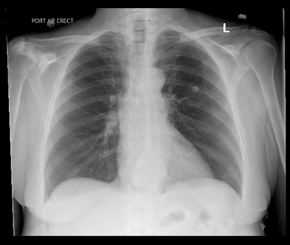 Chest radiograph. Chest X-ray demonstrating no acute cardiopulmonary abnormalities.
