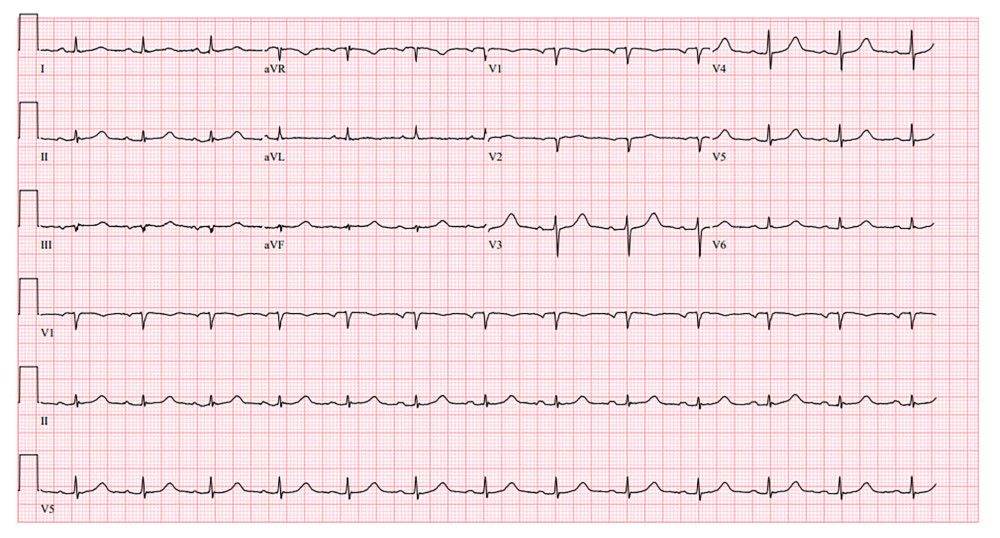 Electrocardiogram. Twelve-lead electrocardiogram showing normal sinus rhythm with no specific ischemic changes.
