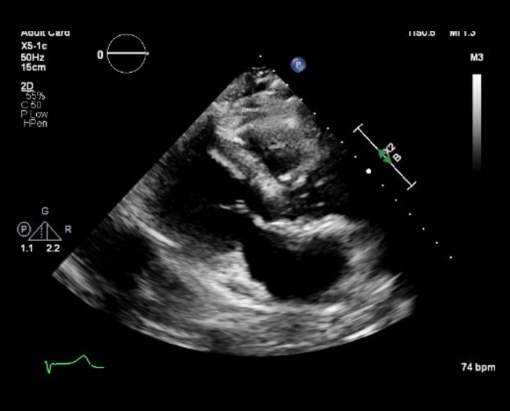 Contrast-enhanced echocardiogram. Contrast-enhanced transthoracic echocardiogram showing severe hypokinesis and akinesis of the basal-to-mid left ventricular segments with preserved apical contraction, consistent with reverse takotsubo cardiomyopathy.