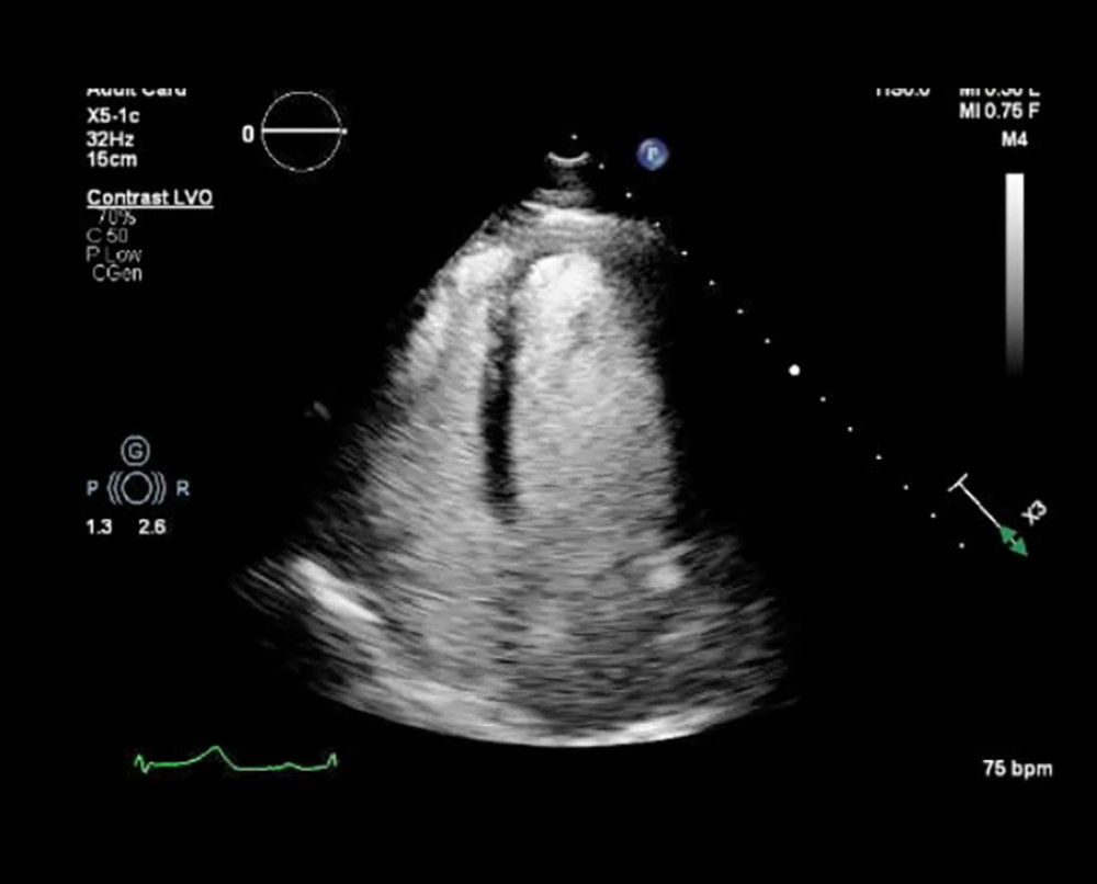 Echocardiogram, parasternal and short-axis views. Standard transthoracic echocardiogram demonstrating basal-predominant dysfunction with apical sparing.