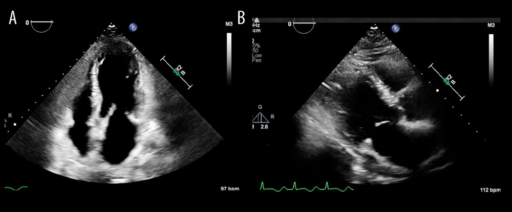 (A) Prior echocardiogram, 4-chamber view. Echocardiogram from the prior admission showing apical hypokinesis with preserved basal function, consistent with classic apical takotsubo cardiomyopathy. (B) Prior echocardiogram, parasternal long-axis view. Parasternal long-axis view from the previous episode demonstrating apical dysfunction with preserved basal contractility.