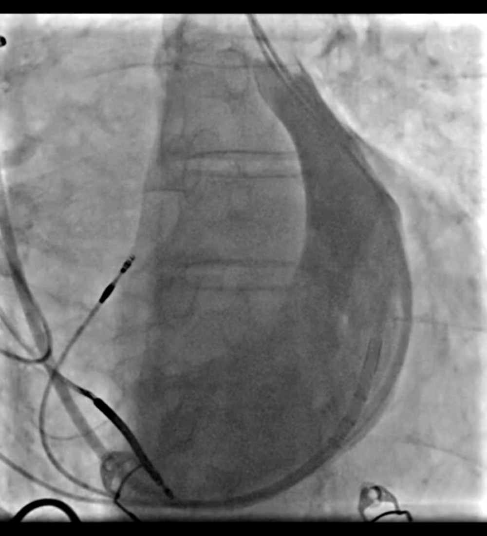Selective coronary sinus venography (contrast injection into the coronary sinus). The fluoroscopic image shows the coronary sinus opacified after contrast injection through a catheter introduced via right-sided venous access. The contrast outlines the main trunk of the coronary sinus without an adequate lateral or posterolateral branch suitable for left ventricular lead implantation.
