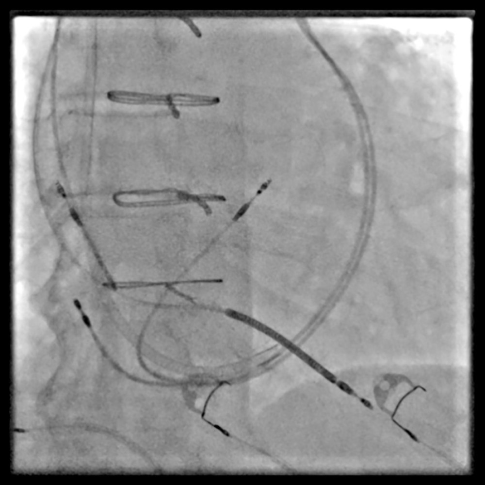 Perioperative X-ray documentation of all implanted leads showing the previously implanted left-sided cardiac resynchronization device leads and the newly implanted right-sided implantable cardiac defibrillator system leads. The image shows the course of the persistent left superior vena cava and the dilated coronary sinus before extraction of the previous cardiac resynchronization therapy pacemaker system, highlighting the anatomical limitation for conventional left ventricle lead placement.