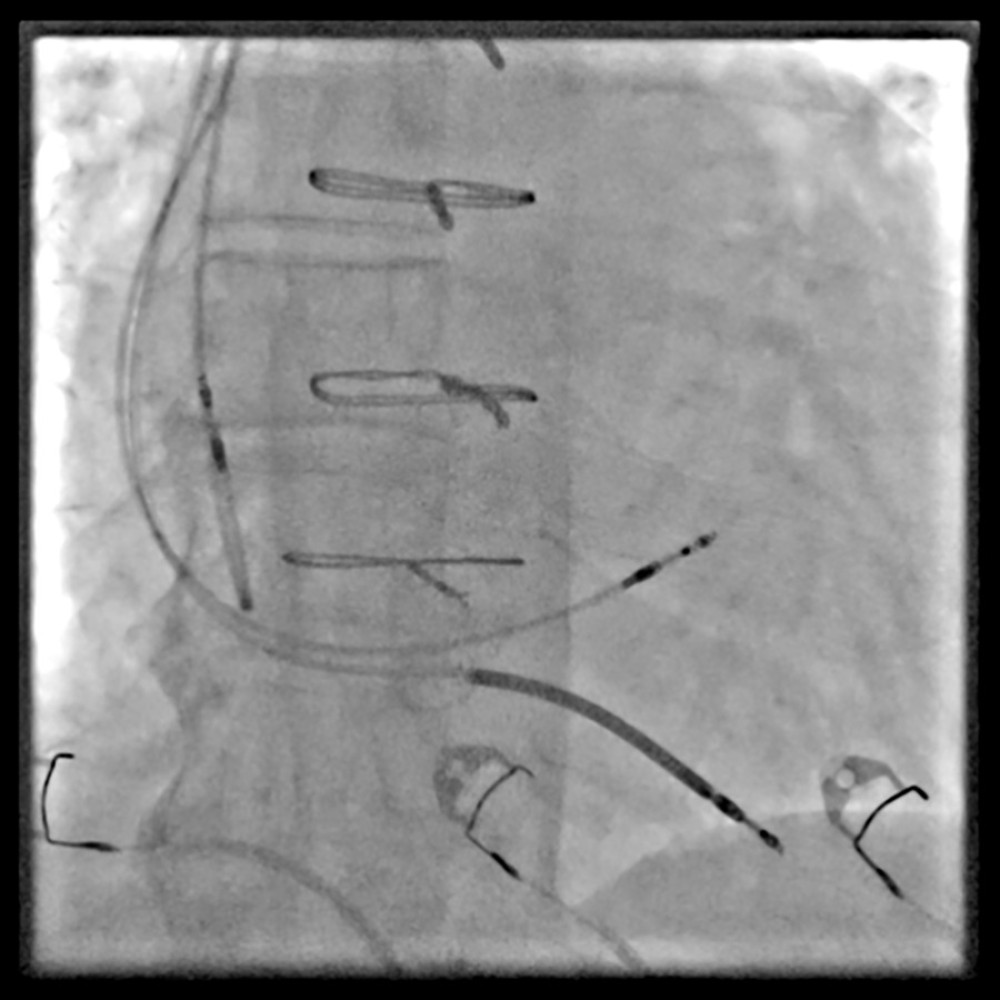 Final perioperative X-ray image with confirmed lead positions. The final fluoroscopic image after implantation of the implantable cardioverter defibrillator system with left bundle branch area pacemaker stimulation demonstrates stable positioning of the left bundle branch area pacemaker lead within the interventricular septum, consistent with effective conduction system capture. The implantable defibrillator lead remains optimally placed in the apical septum, and the right atrial lead shows appropriate fixation. This final radiograph confirms correct depth and orientation of the left bundle branch area pacemaker lead, ensuring reliable physiological pacing and anticipated resynchronization.