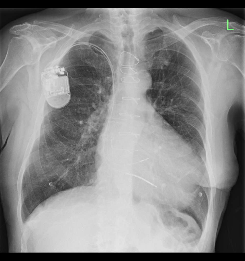 Upright chest X-ray on postoperative day 1. Chest radiograph obtained on postoperative day 1 confirming stable positions of all conduction system pacing-related leads, without evidence of dislodgement. The left bundle branch area pacemaker lead maintains appropriate septal orientation, indicative of sustained conduction system engagement. No pneumothorax or early postoperative complications are present.