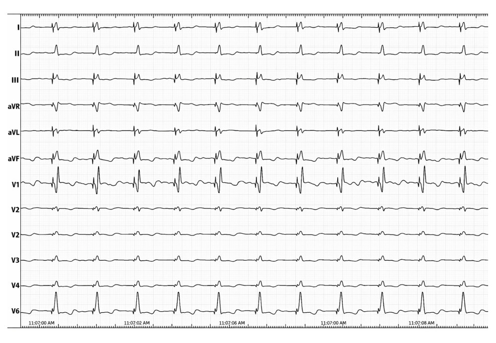 Postoperative electrocardiogram recording. Postoperative electrocardiogram demonstrating non-selective left bundle branch area pacing, characterized by a paced QRS duration of 120 ms.