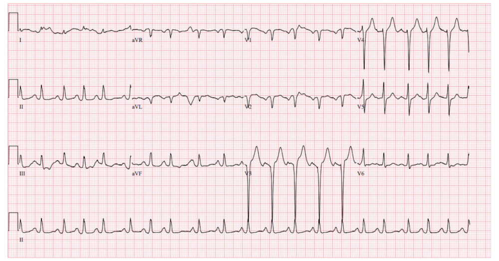Initial electroencephalogram showing sinus tachycardia with ST-T wave changes and old anteroseptal myocardial infarction.