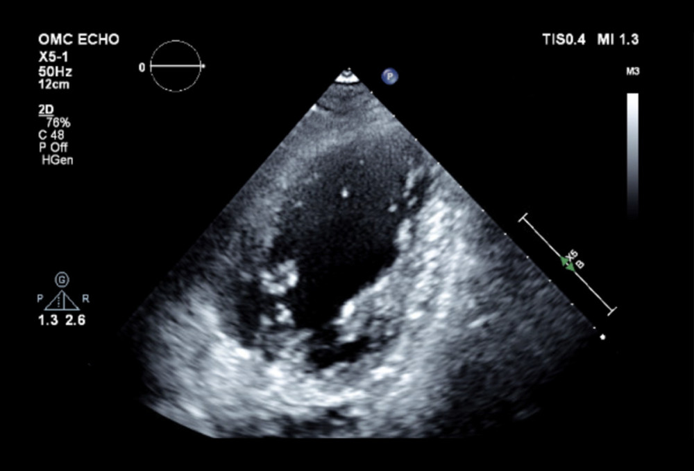 2D echocardiogram demonstrated severe hypokinesis of the proximal 2/3 of the septal wall anterior lateral and posterior with apical sparing consistent with reverse takotsubo cardiomyopathy and new left ventricle ejection fraction of 40%.