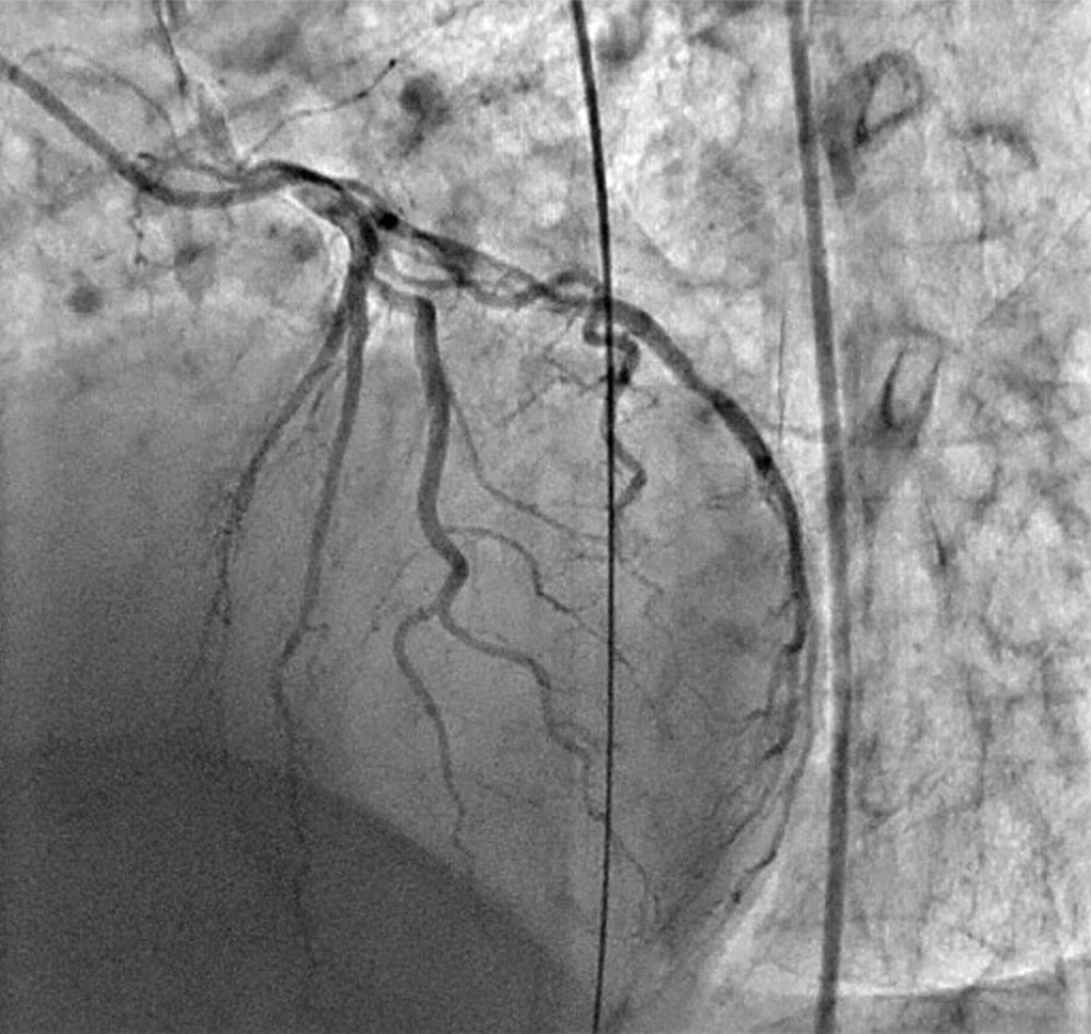 Cardiac catheterization with no new obstructive culprit lesions suggesting takotsubo cardiomyopathy.