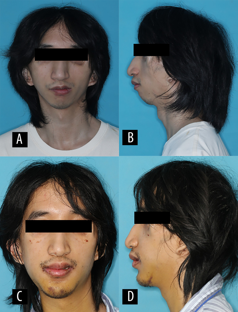 Facial photographs. (A, B) Preoperative frontal and lateral views. (C, D) Postoperative frontal and lateral views after orthognathic surgery.