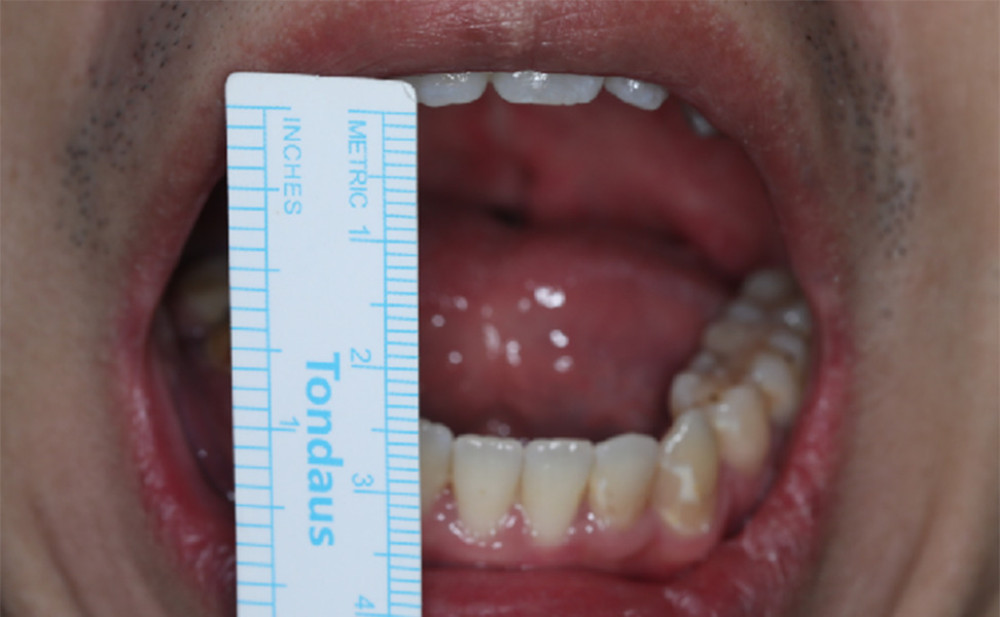 Clinical assessment of mouth opening.